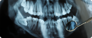 image extraction simple et complexe de dents