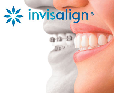 Invisalign